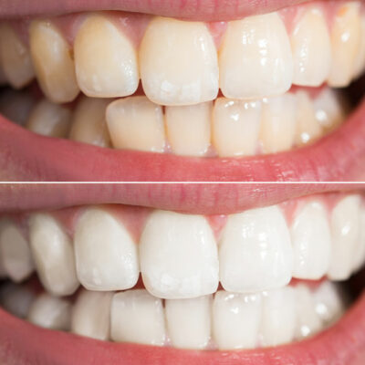 3 Easy Yet Effective Ways to Whiten Teeth