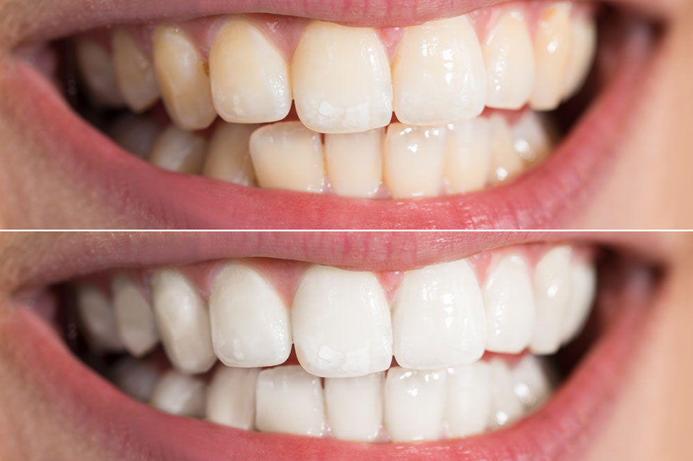 3 Easy Yet Effective Ways to Whiten Teeth
