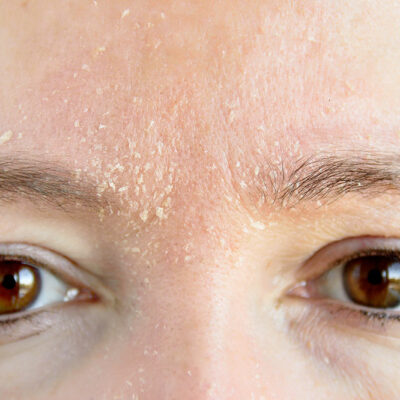 Atopic Dermatitis – American Cities to Avoid