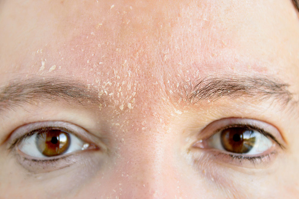 Atopic Dermatitis – American Cities to Avoid