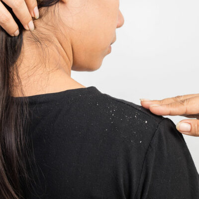 Natural Ways to Keep Dandruff Away
