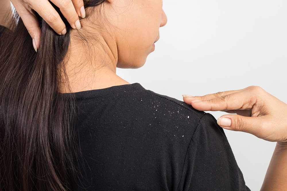 Natural Ways to Keep Dandruff Away